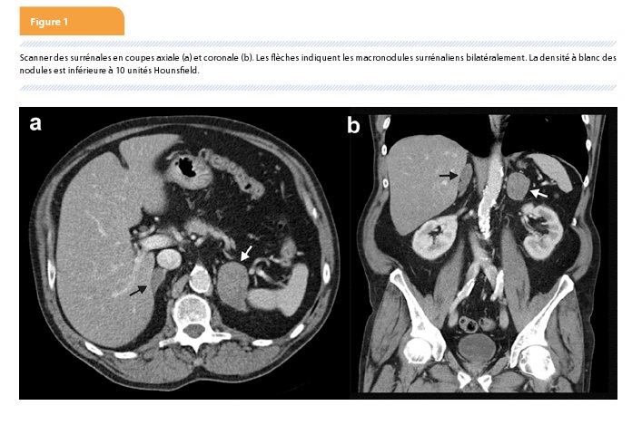 Diagnostic d'une hyperplasie macronodulaire bilatérale des ...