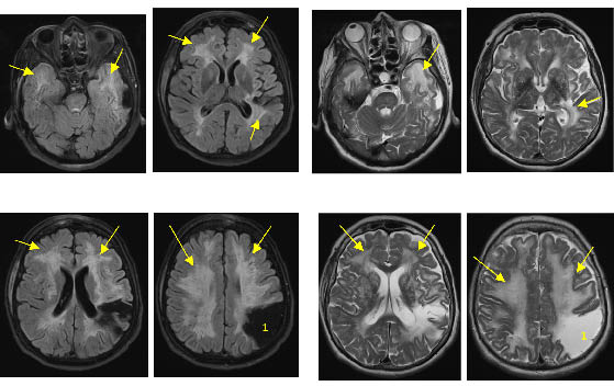 Bilan de troubles cognitifs et de chutes conduisant au diagnostic ...