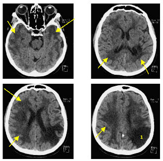  Bilan de troubles cognitifs et de chutes conduisant au diagnostic dangiopathie cérébrale de type CADASIL