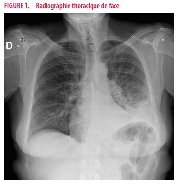 Pneumopathies à Legionella Pneumophila | Louvain Médical