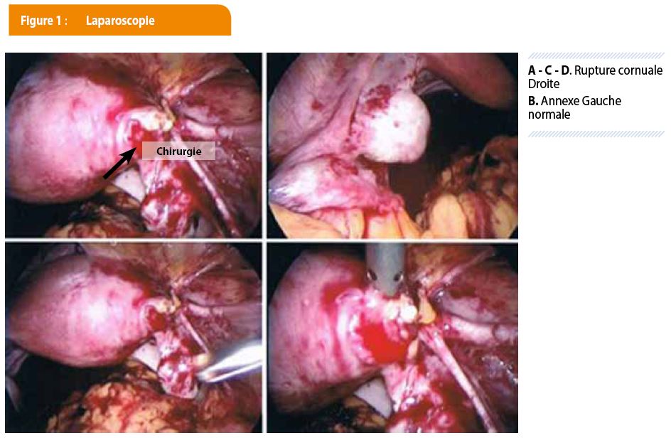 Un cas rare de grossesse extra-utérine : la grossesse cornuale ...