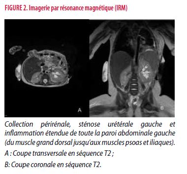 Choc septique et pyomyosite causés par un Staphylocoque doré ...