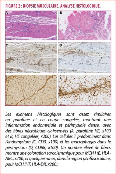 Dermatomyosite à anticorps anti-SAE 1/2 dans le décours d'un ...