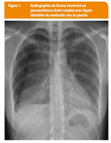 Pneumothorax et sclérose tubéreuse de Bourneville | Louvain Médical