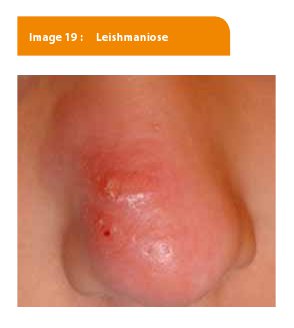 Dermatoses topographiques | Louvain Médical