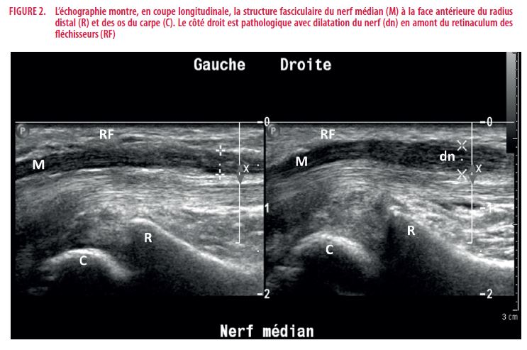 Docteur, j'ai la main qui picote | Louvain Médical