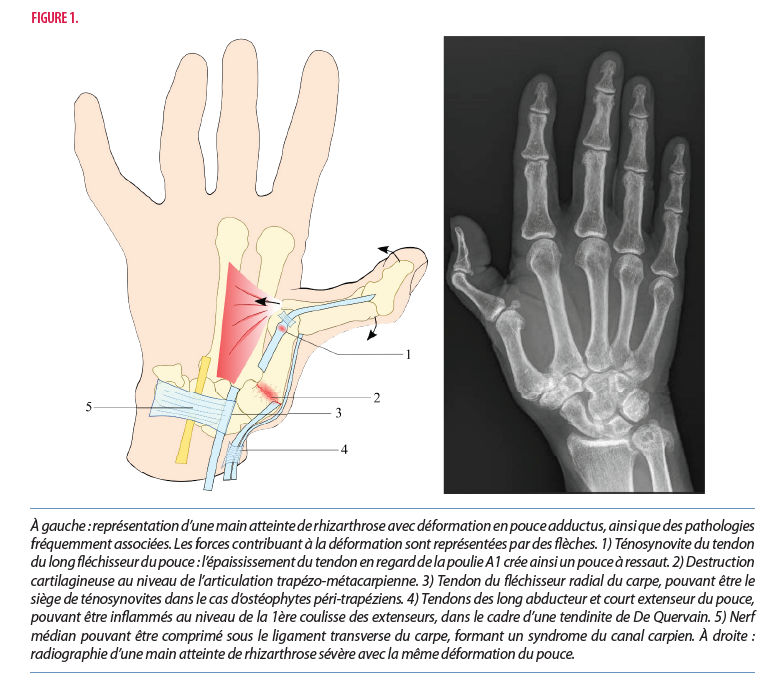 Rhizarthrose ou arthrose du pouce - Groupe Clinique Drouot