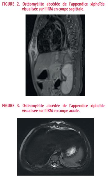Ostéomyélite sternale chez un enfant de 15 mois : cas clinique et ...