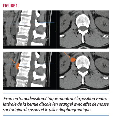Une hernie discale lombaire ventrale, une topographie et ...