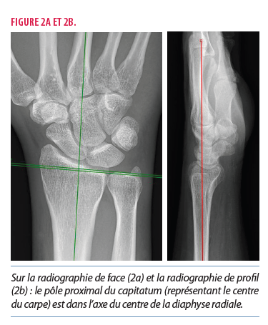 Prise en charge d'une fracture du radius distal chez l'adulte : le ...