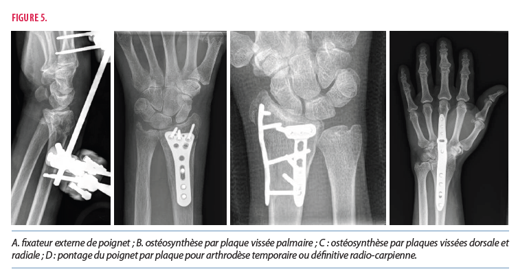 Prise en charge d'une fracture du radius distal chez l'adulte : le ...