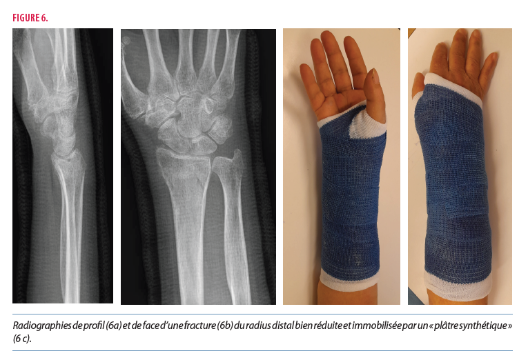 Prise en charge d'une fracture du radius distal chez l'adulte : le ...