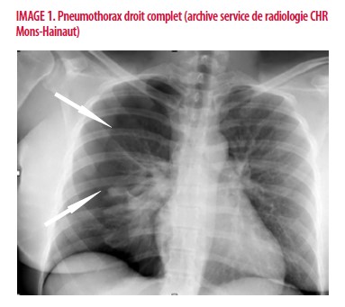 Pneumothorax spontané chez une femme enceinte : difficulté de ...