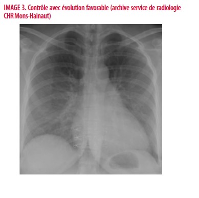 Pneumothorax spontané chez une femme enceinte : difficulté de ...