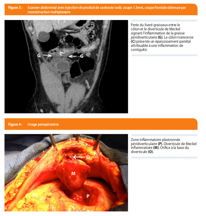 Perforation spontanée d'un diverticule de Meckel | Louvain Médical