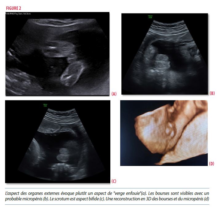 Echographie de grossesse morphologique du DEUXIEME TRIMESTRE sans